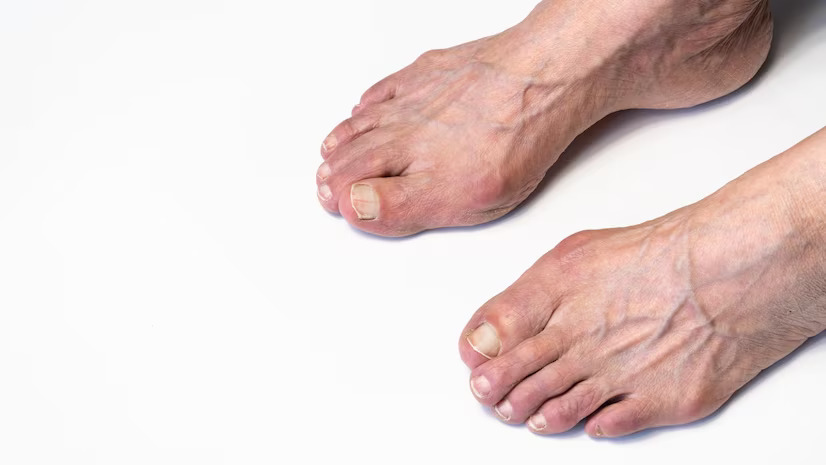 Foot Deformities